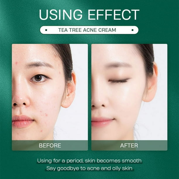 BEUKING Tea Tree Oil Acne Face Cream - Soothing and Nourishing Non-Greasy Moisturizer for Oily, Acne-Prone Skin, Balances and Hydrates with Botanical Ingredients
